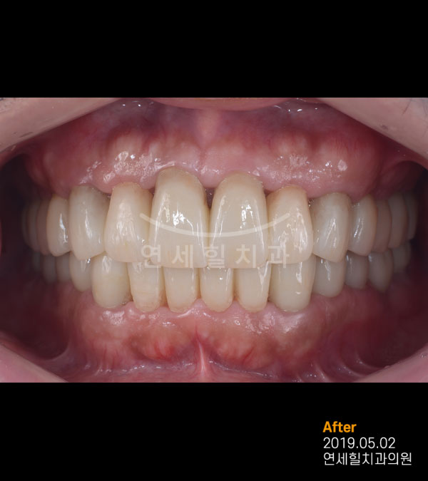 implant after 症例10 韓国 ヨンセヒール歯科