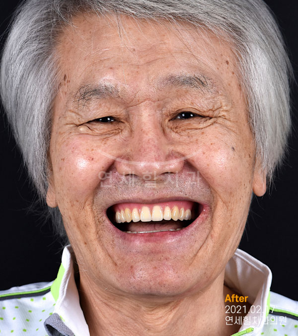 implant after 症例3 韓国 ヨンセヒール歯科