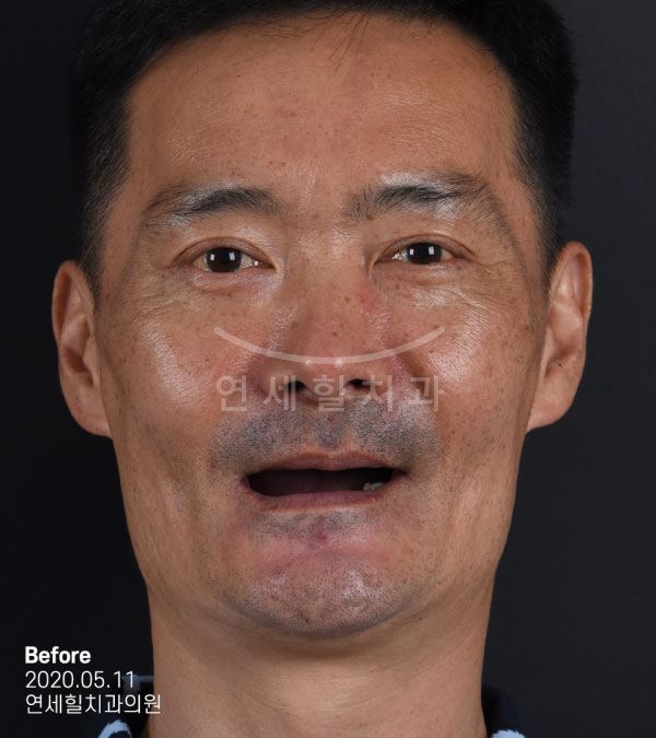 implant before 症例4 韓国 ヨンセヒール歯科