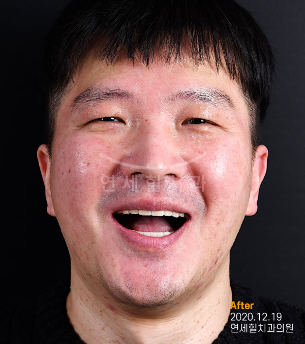 implant after 症例5 韓国 ヨンセヒール歯科