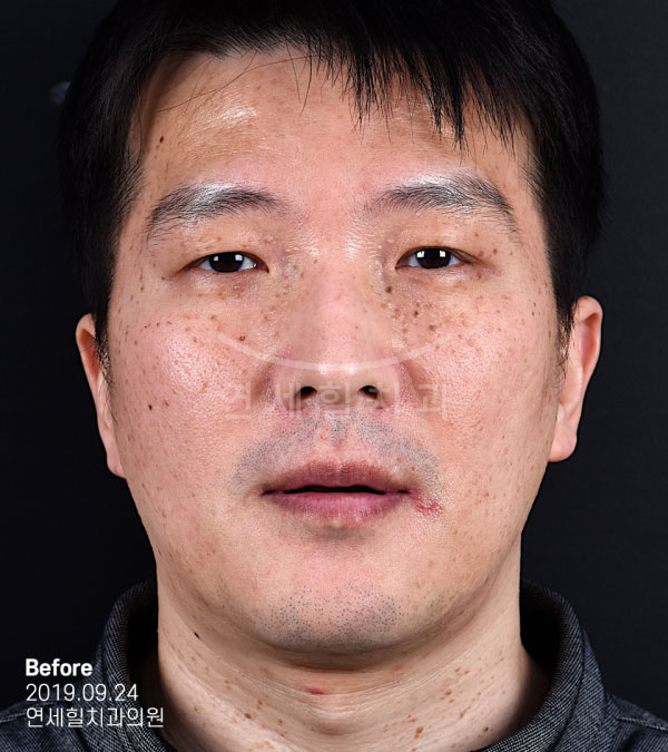 implant before 症例5 韓国 ヨンセヒール歯科