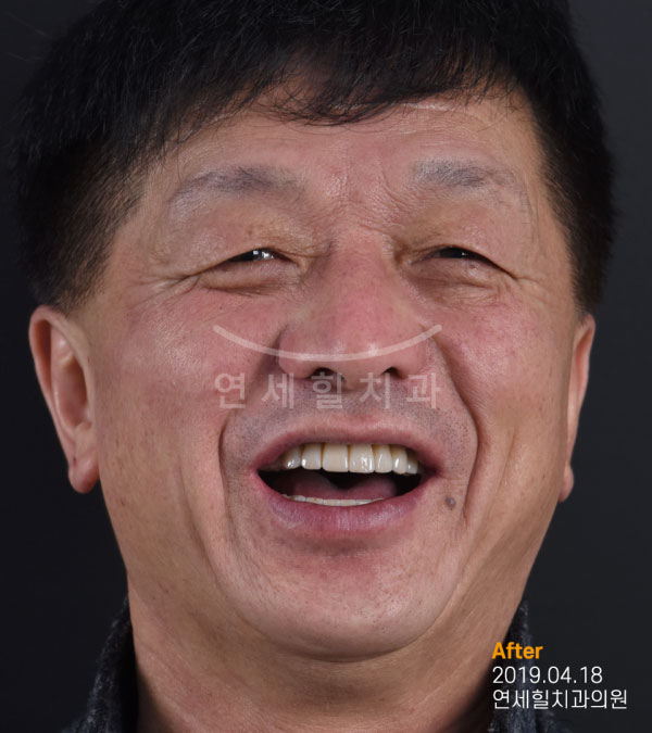 implant after 症例6 韓国 ヨンセヒール歯科