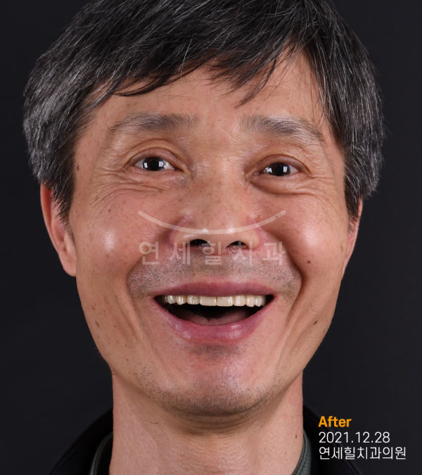 implant after 症例7 韓国 ヨンセヒール歯科