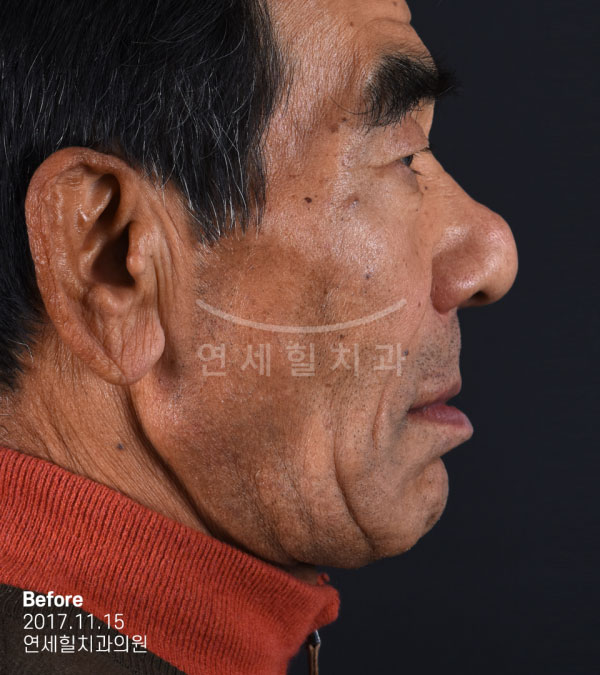 implant before 症例9 韓国 ヨンセヒール歯科